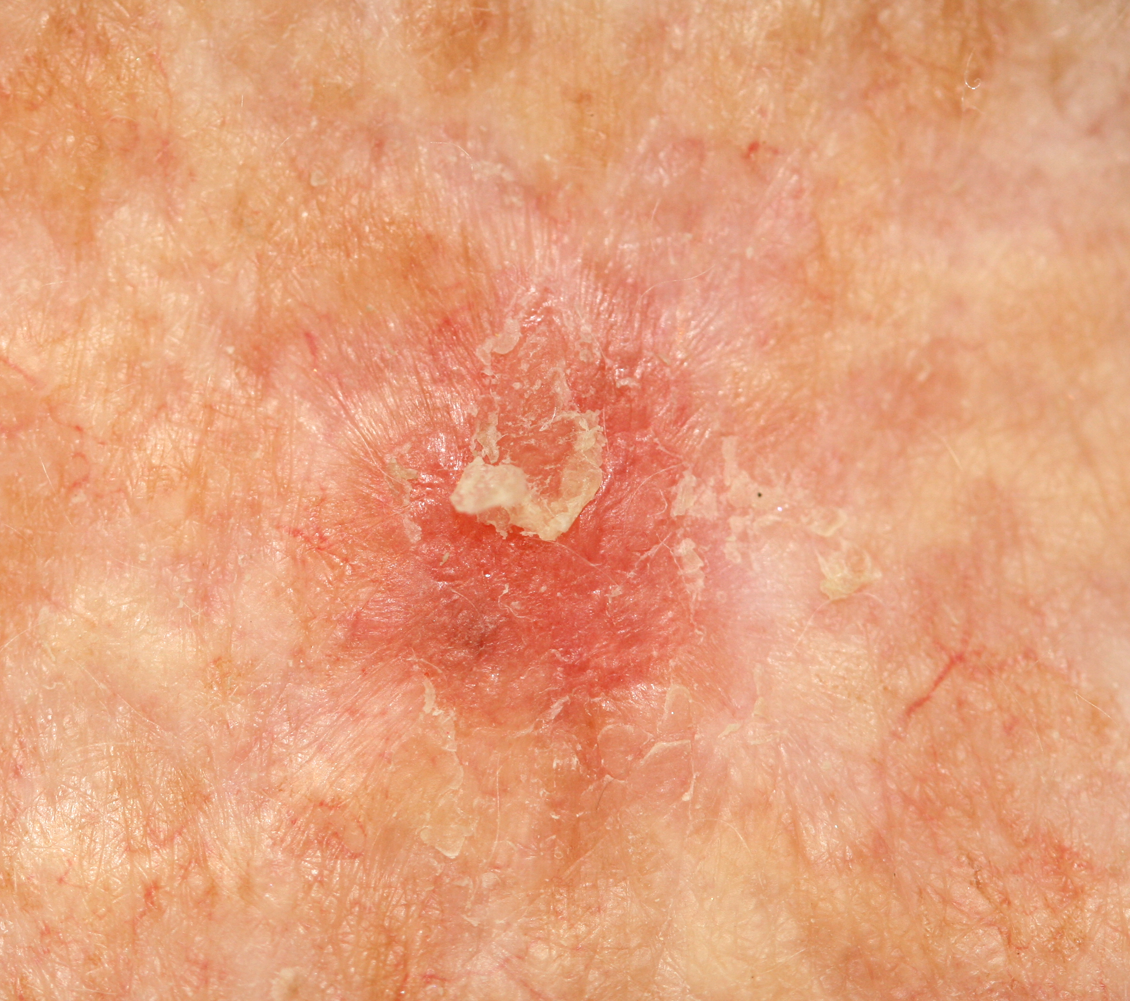 A,Case,Of,Actinic,(solar),Keratosis.