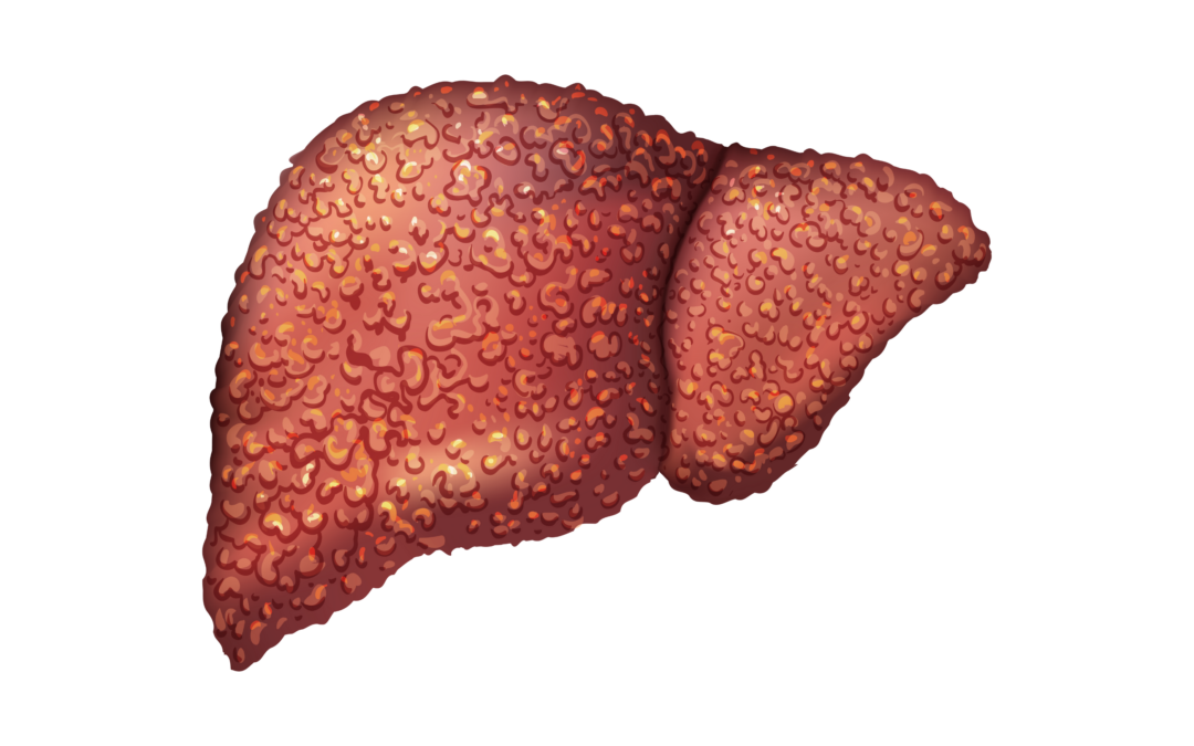 Le nombre de cas du cancer du foie pourrait doubler d’ici 2050