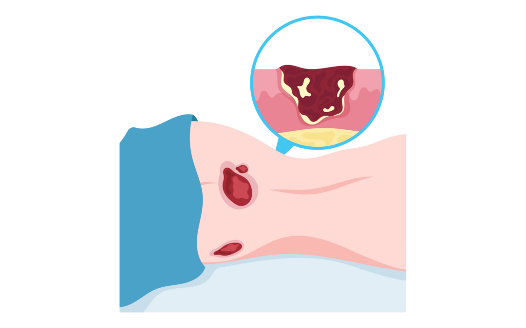 L’UZ Gent réduit de moitié le nombre d’escarres grâce à une prévention systématique