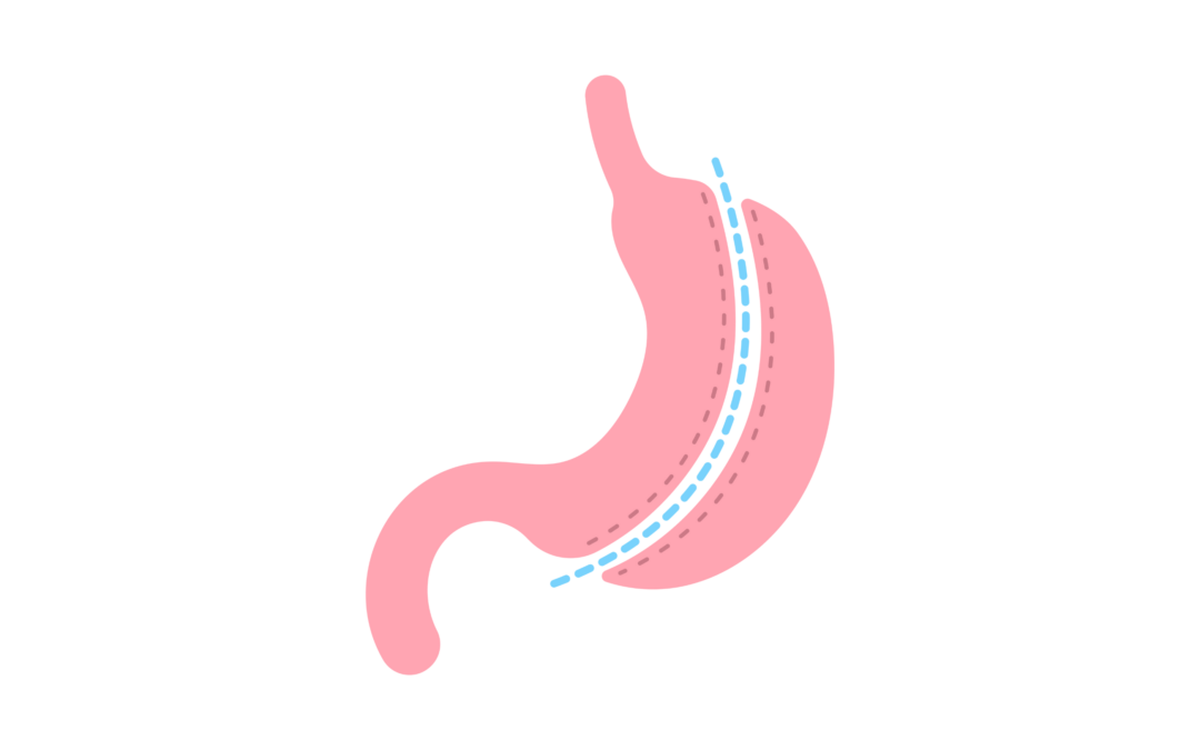Chirurgie bariatrique et risque d’addiction à l’alcool