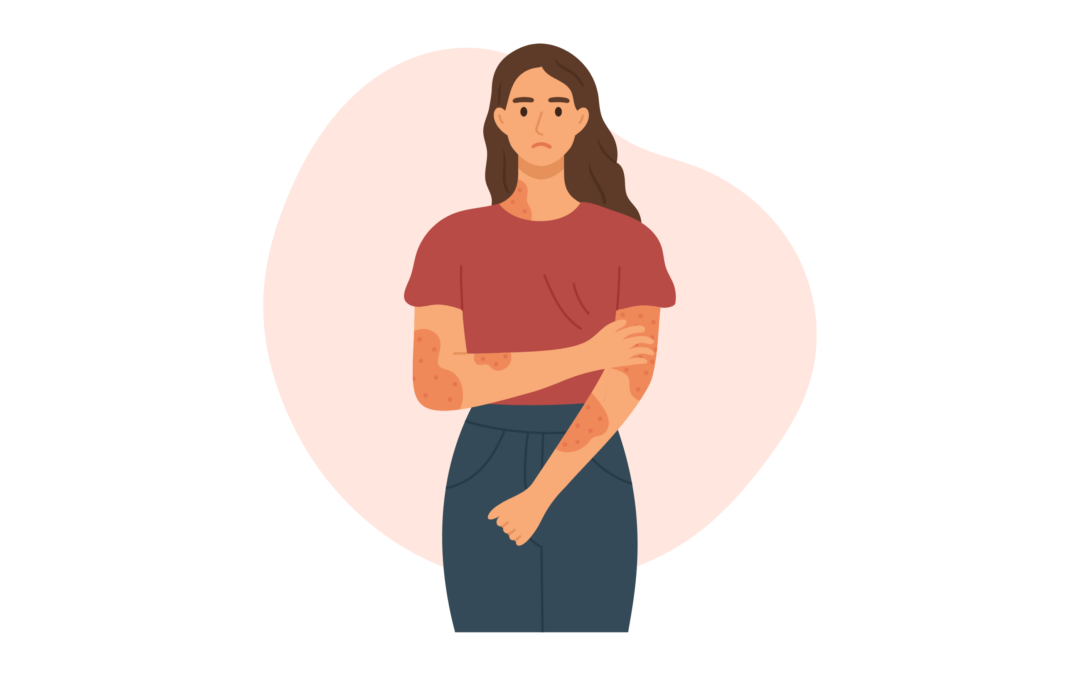 Psoriasis : moins de biothérapie, même efficacité