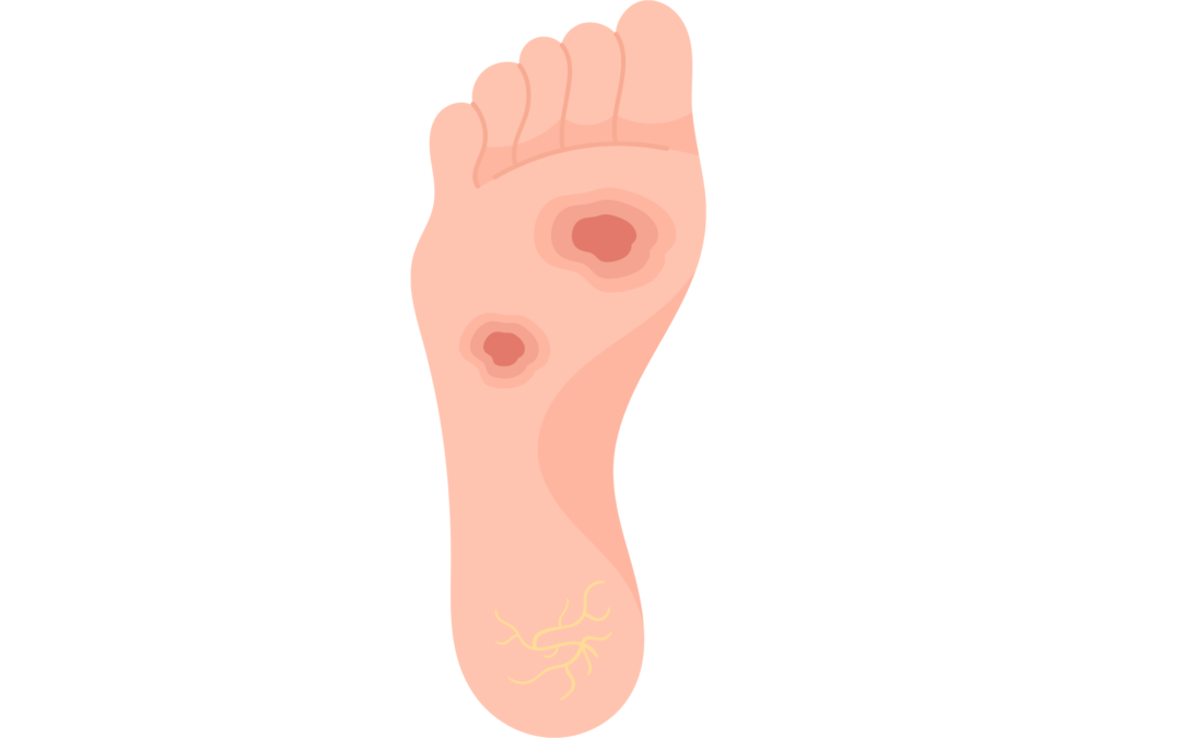 Un kit pour aider les patients diabétiques à mieux surveiller leurs pieds