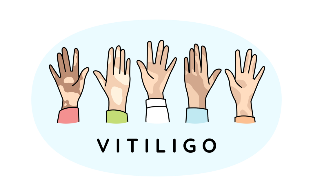 Près d’un patient sur quatre atteint de vitiligo souffre de dépression sévère