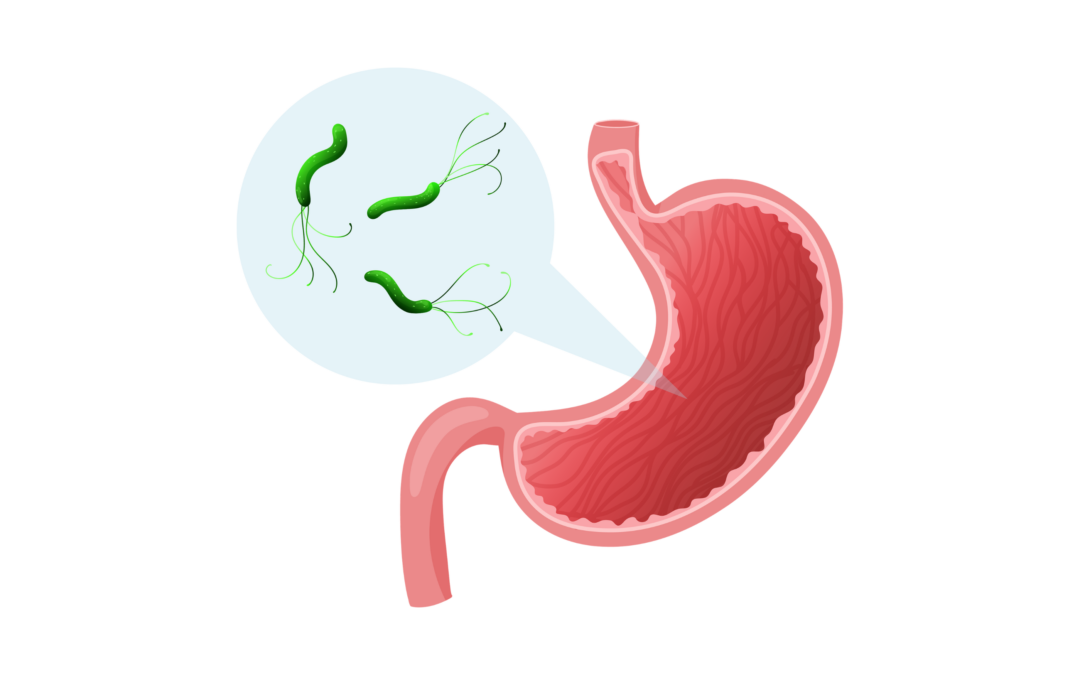 Helicobacter pylori : un rôle bien établi dans l’estomac, une nouvelle piste dans le cancer colorectal